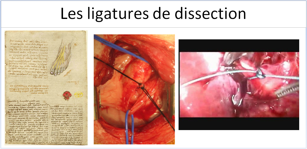 Les ligatures de dissection